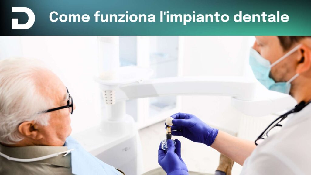 come funziona l'impianto dentale | news | dentalian