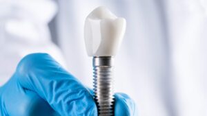 Impianto Dentale A Carico Immediato O Differito: Facciamo Chiarezza - Foto 5