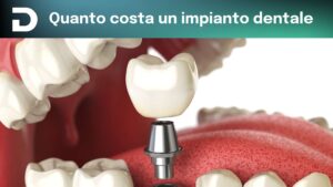 quanto costa un impianto dentale | news | dentalian