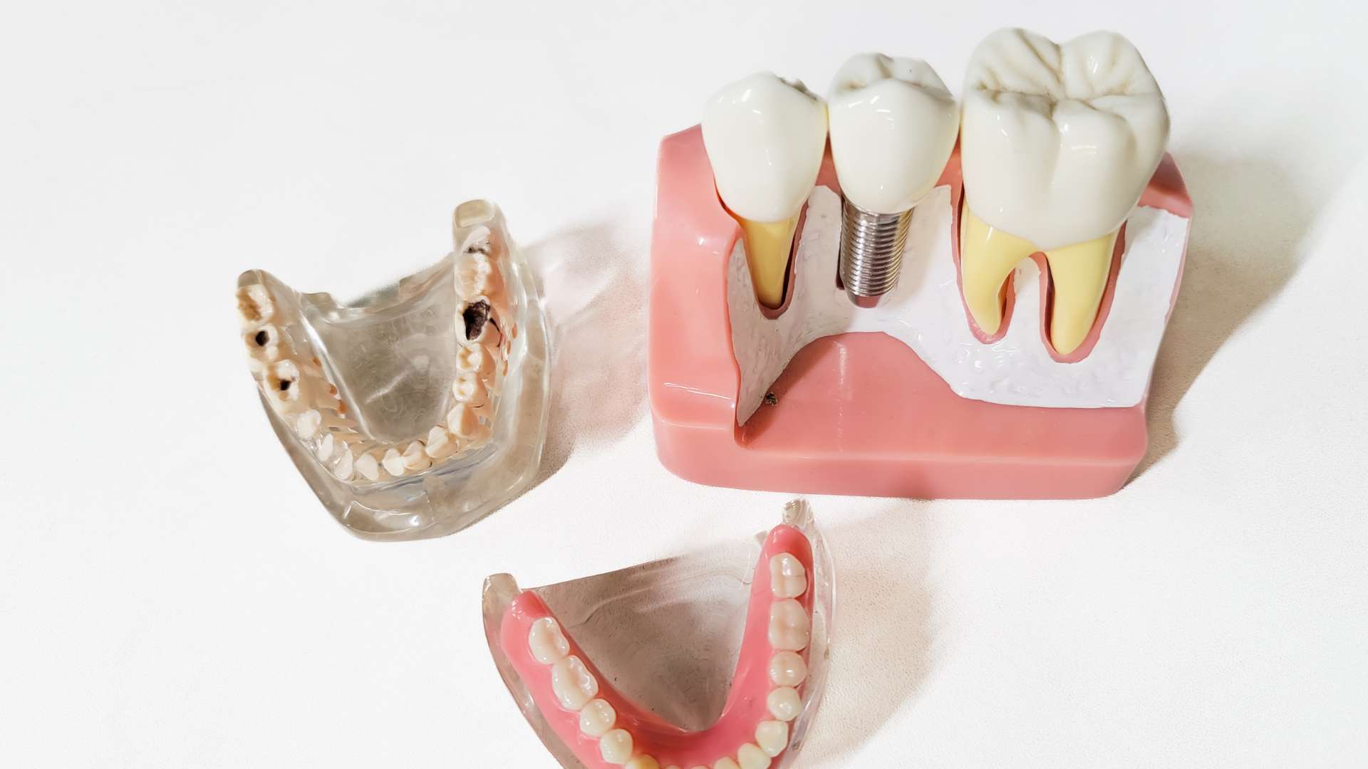 Quanto dura un impianto dentale? (Aggiornato al 2025)
