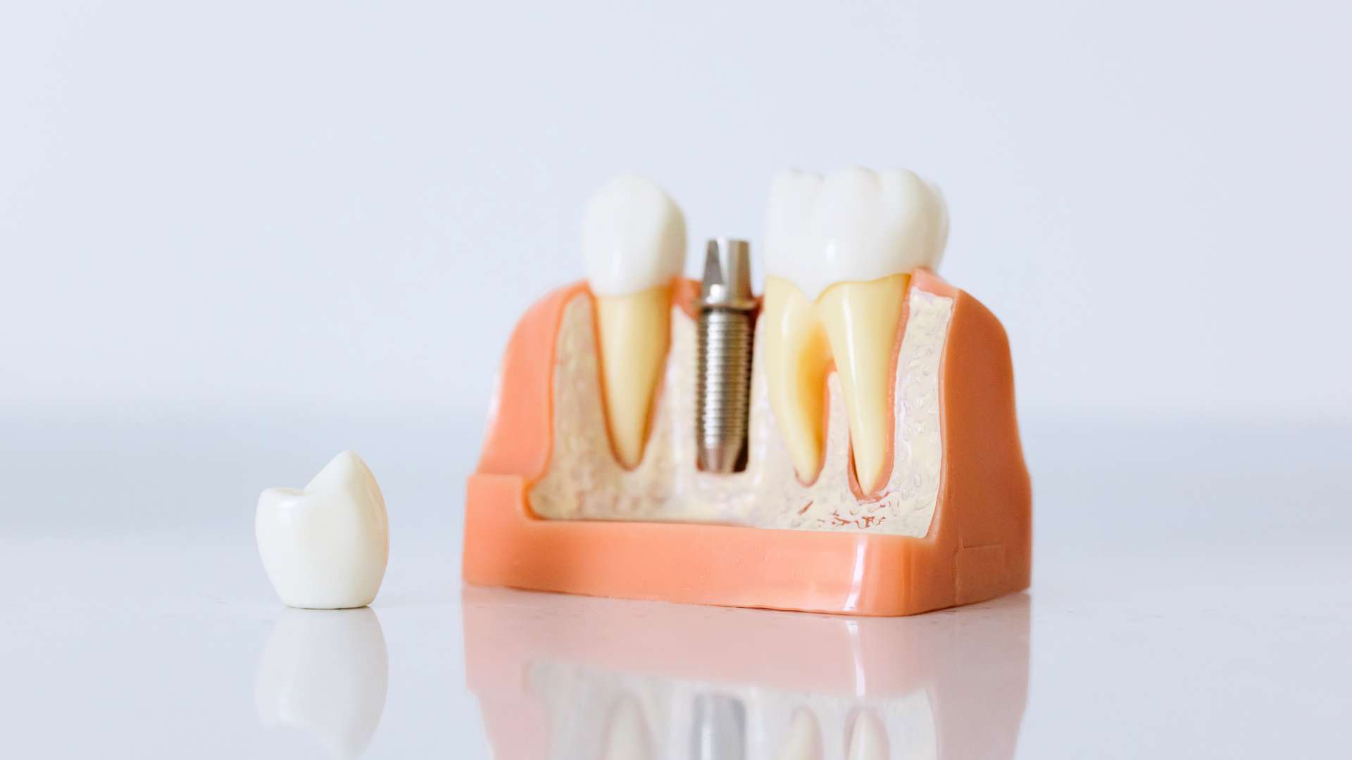 Quanto dura un impianto dentale? (Aggiornato al 2025)