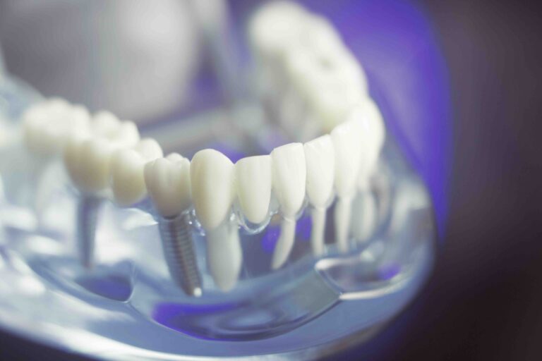 quante sedute per un impianto dentale