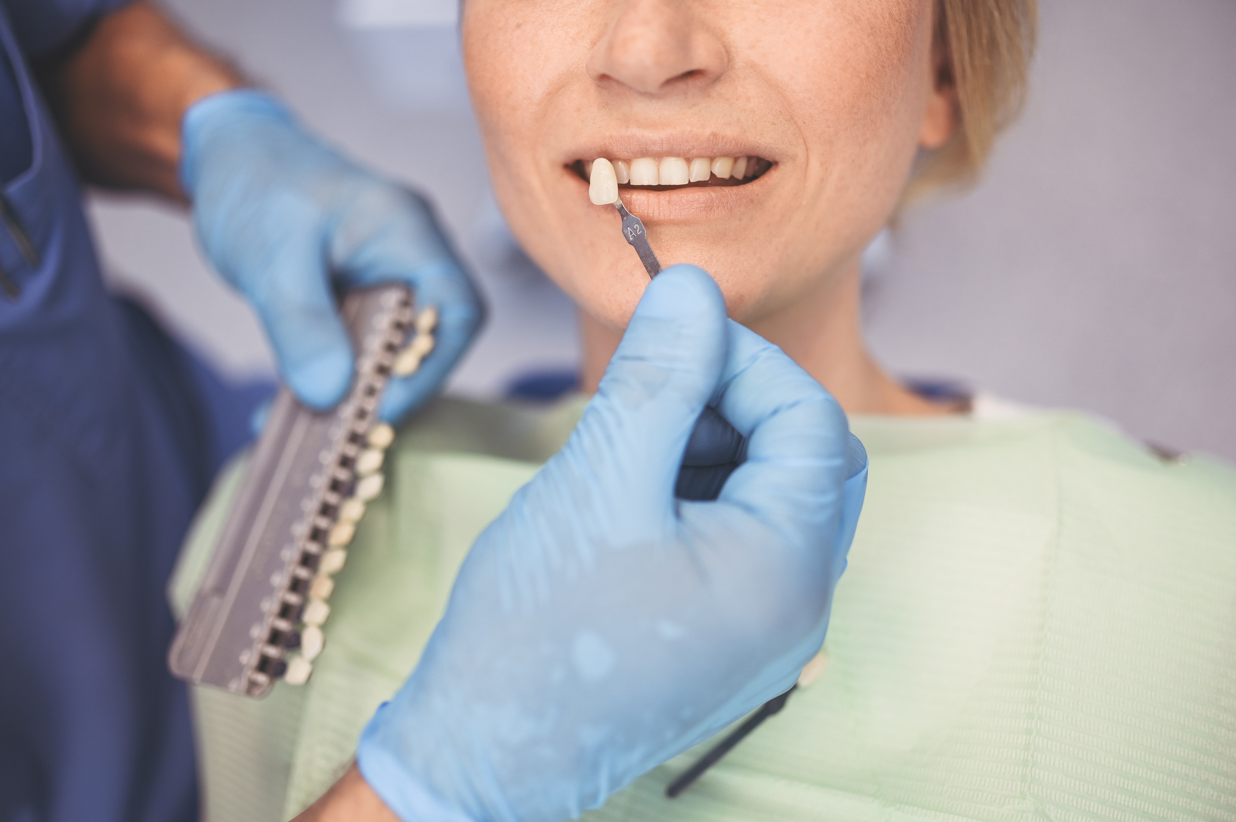 Cosa sono le faccette dentali