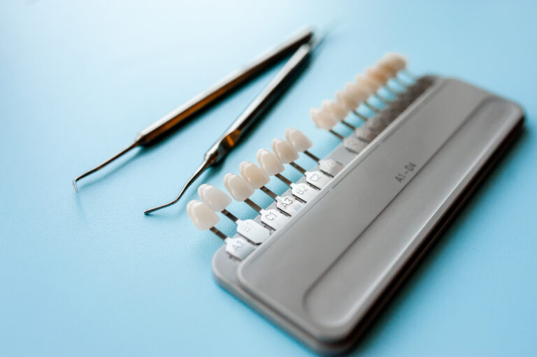 Come si mettono le faccette dentali