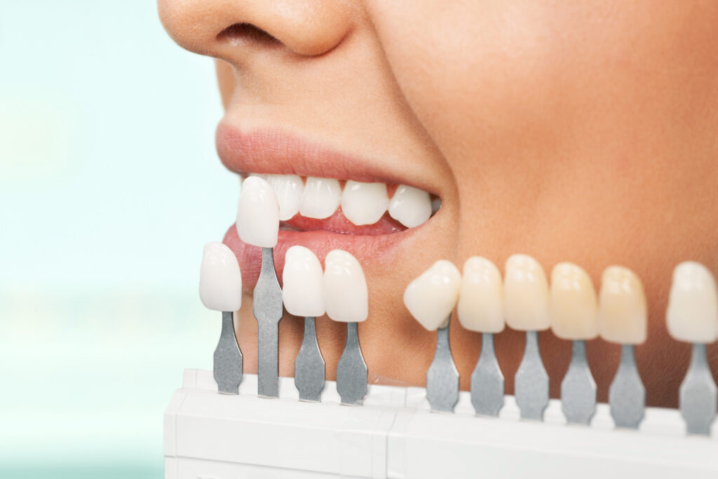 Come si fanno le faccette dentali