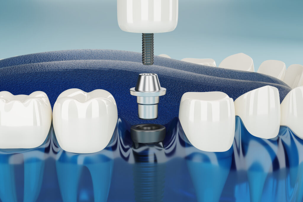 Come fare impianto dentale senza osso