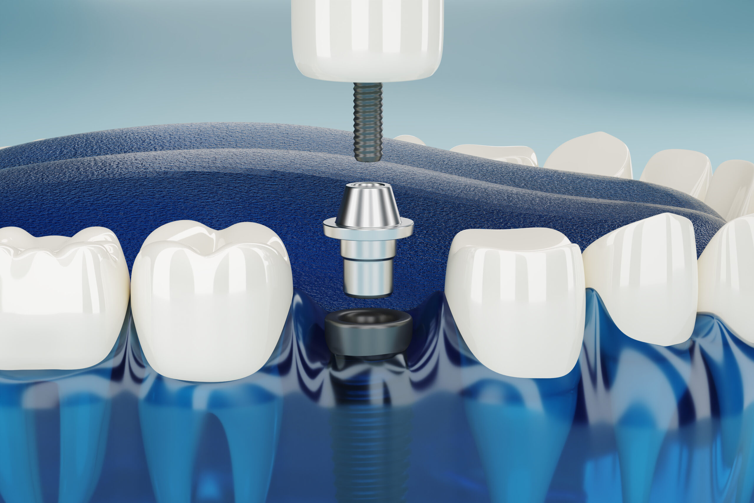 Come fare impianto dentale senza osso