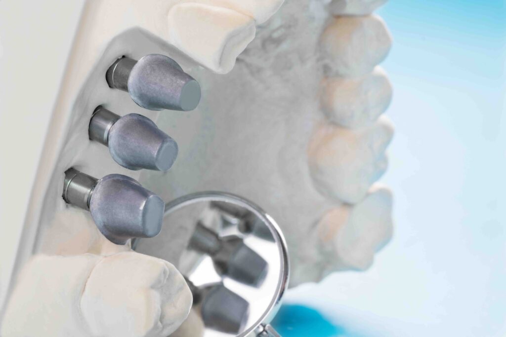 Quanto costa un impianto dentale
