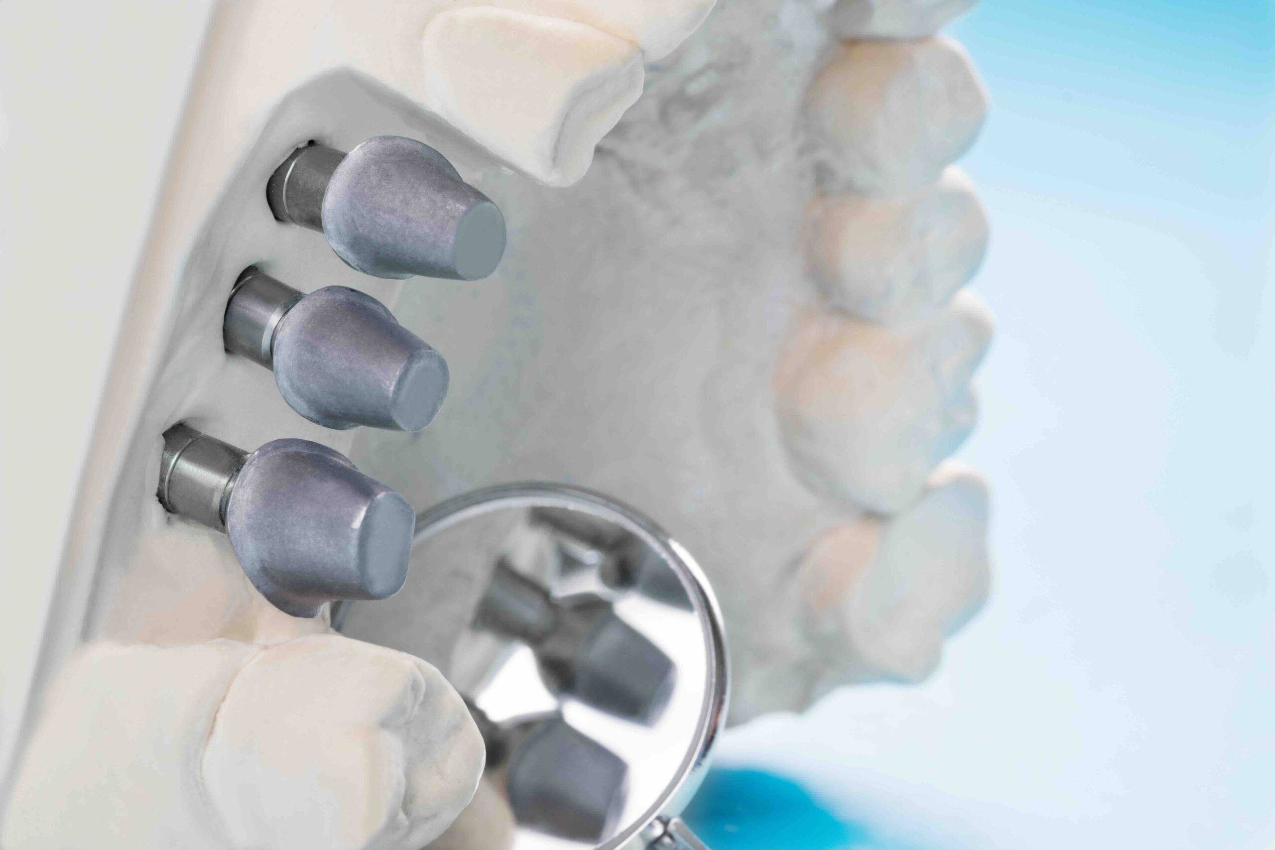 Quanto costa un impianto dentale