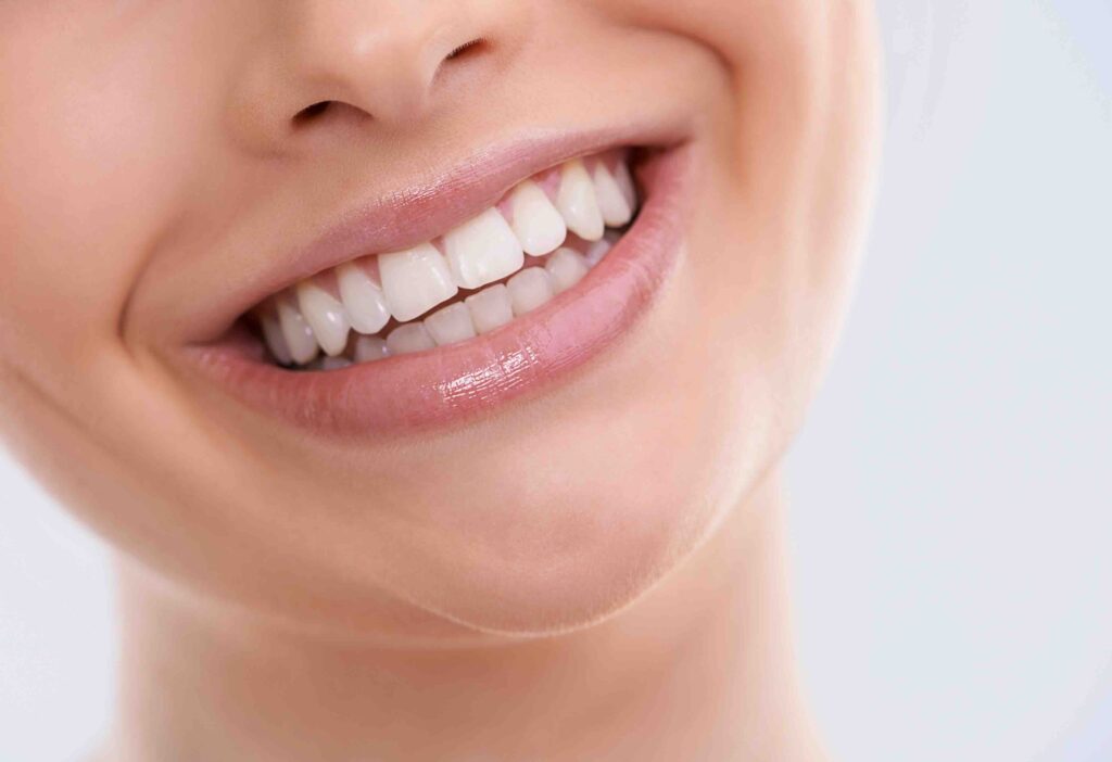 Cosa sono le faccette dentali