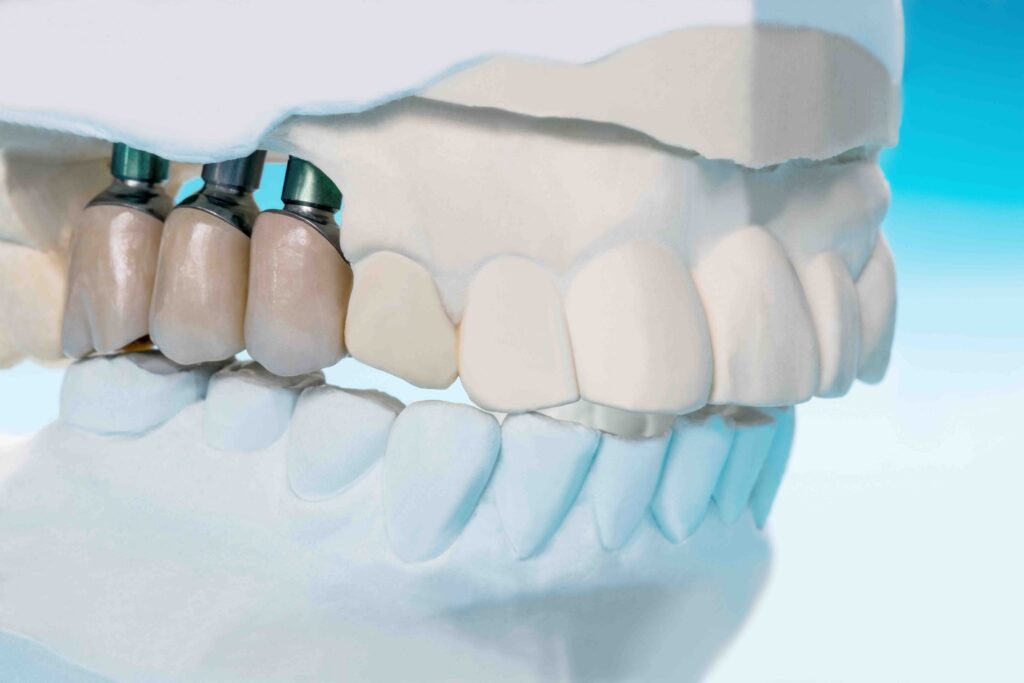 Cosa mangiare dopo impianto dentale