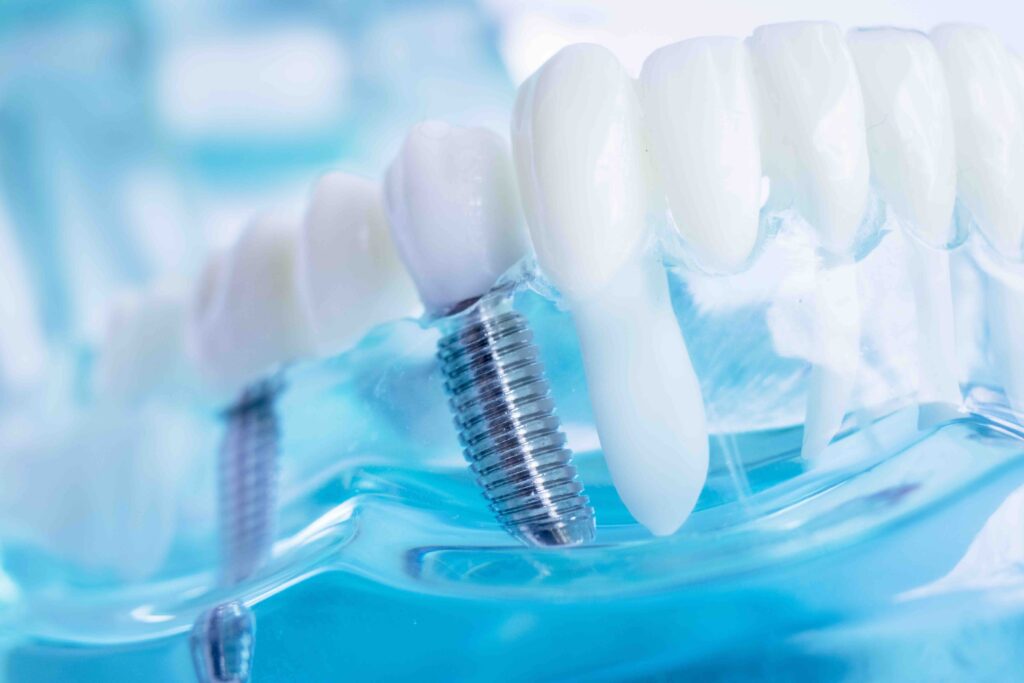 Rigetto impianto dentale