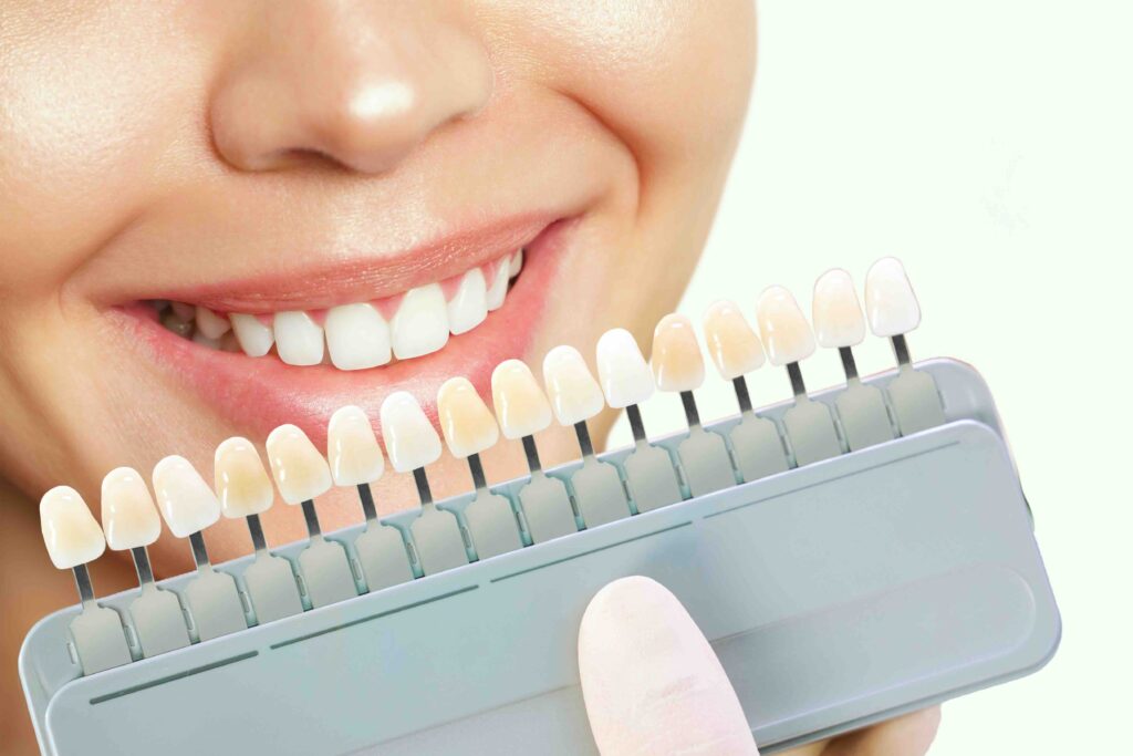 come cambiano i denti con le faccette
