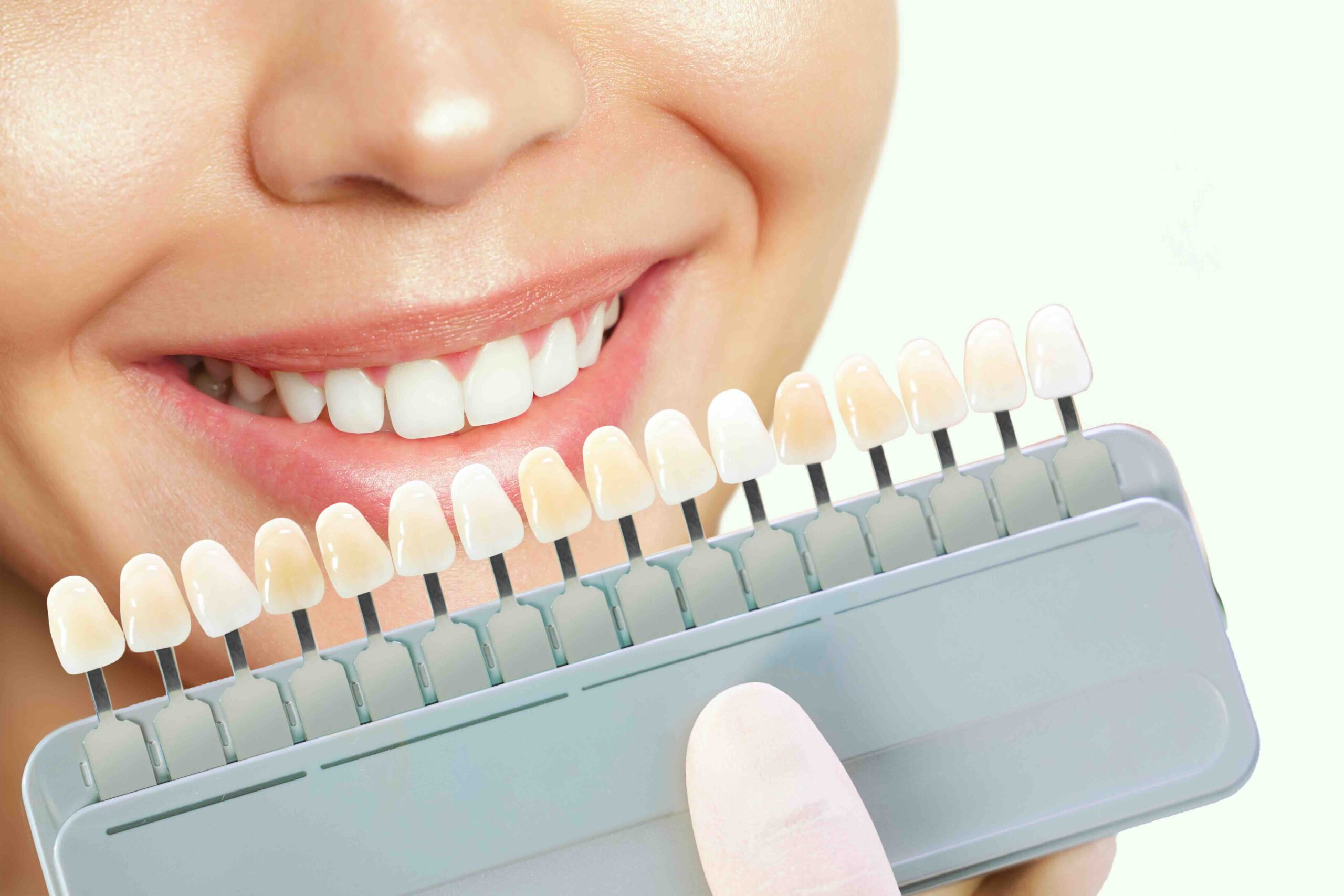 come cambiano i denti con le faccette