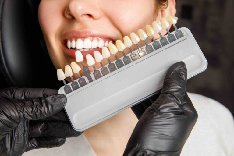 Come scegliere il colore delle faccette dentali
