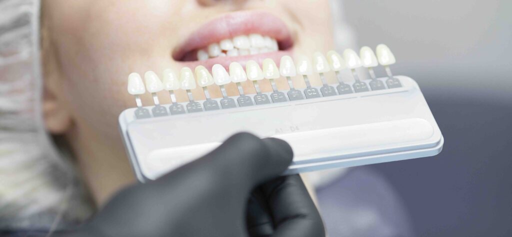 quando mettere le faccette dentali